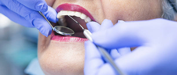Best Knocked-Out Tooth (Avulsed Tooth) Treatment in USA